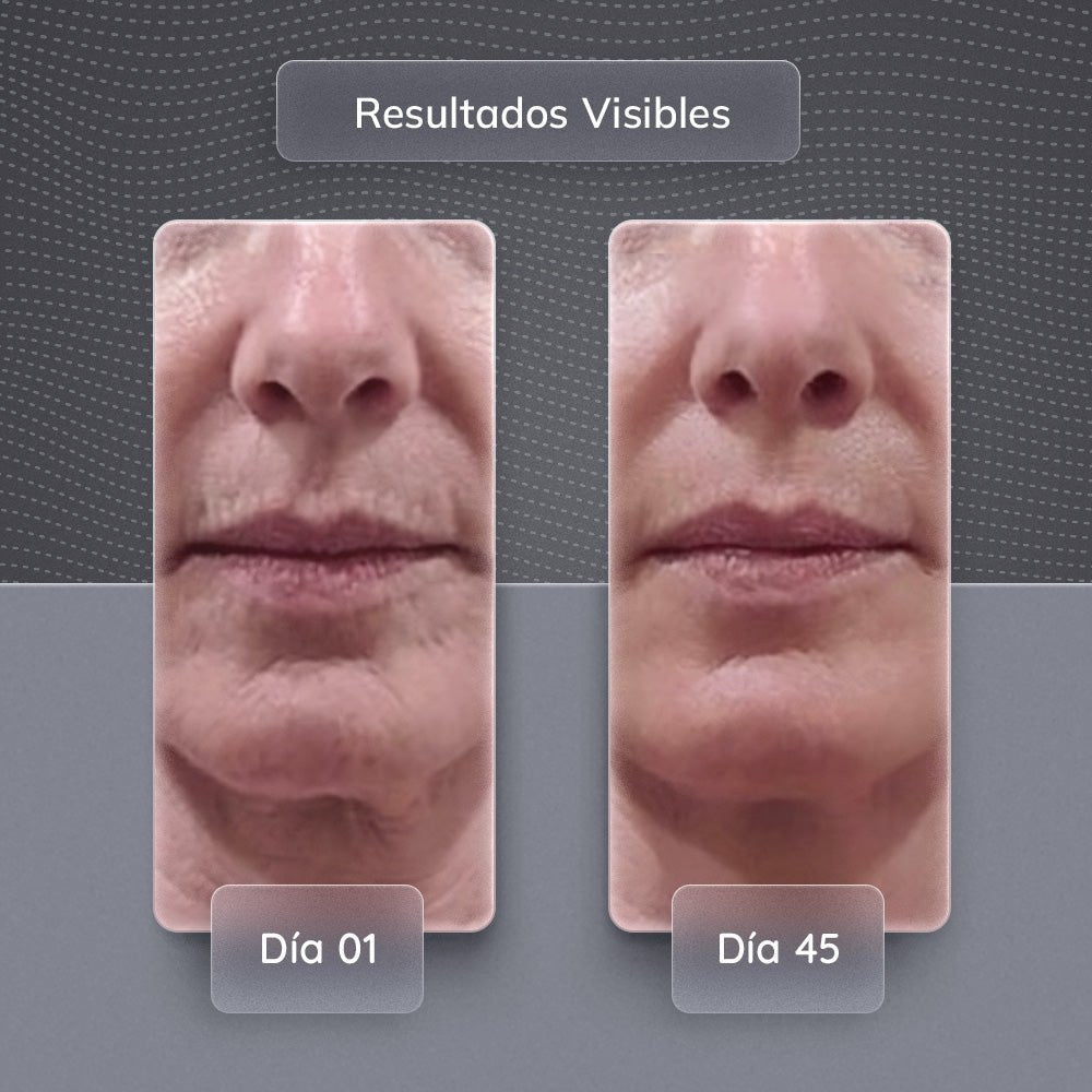 Skindion™ Dispositivo de Rejuvenecimiento Facial